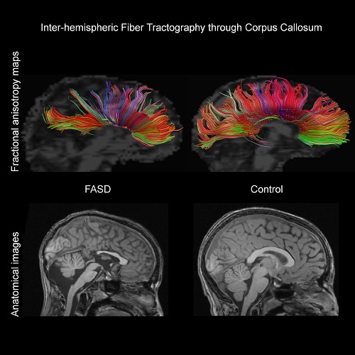 FASD vs control brain scans