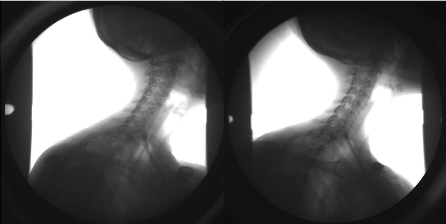 Biplane radiography allows Ellingson to capture bony movement in patients