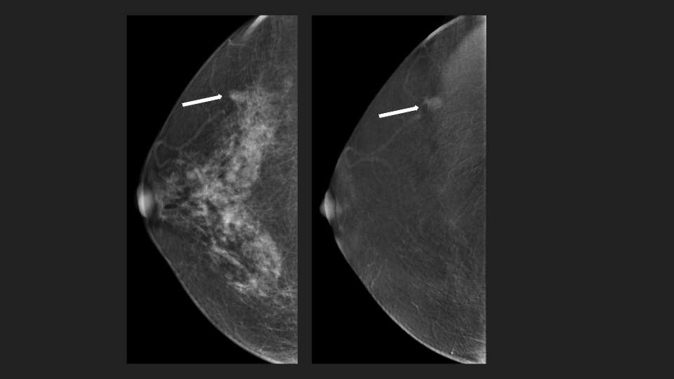 Mammography Scan