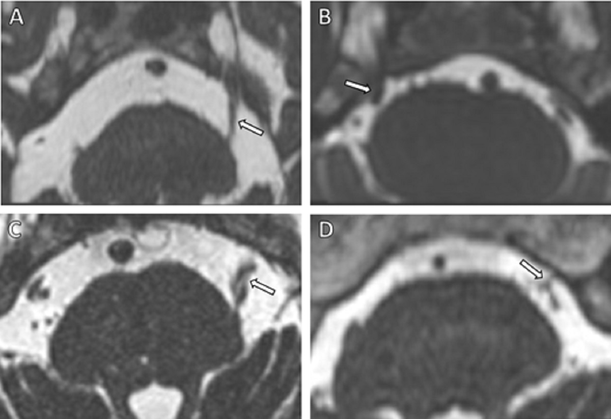 MRI used in trigeminal neuralgia study