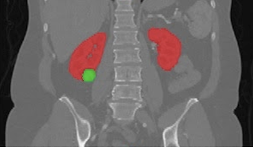 segmentation of kidneys and malignancies