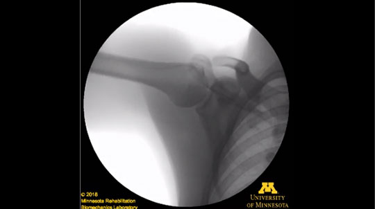 X-ray of a shoulder