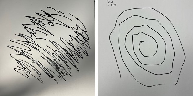 Spirals drawn by patient before and after DBS surgery