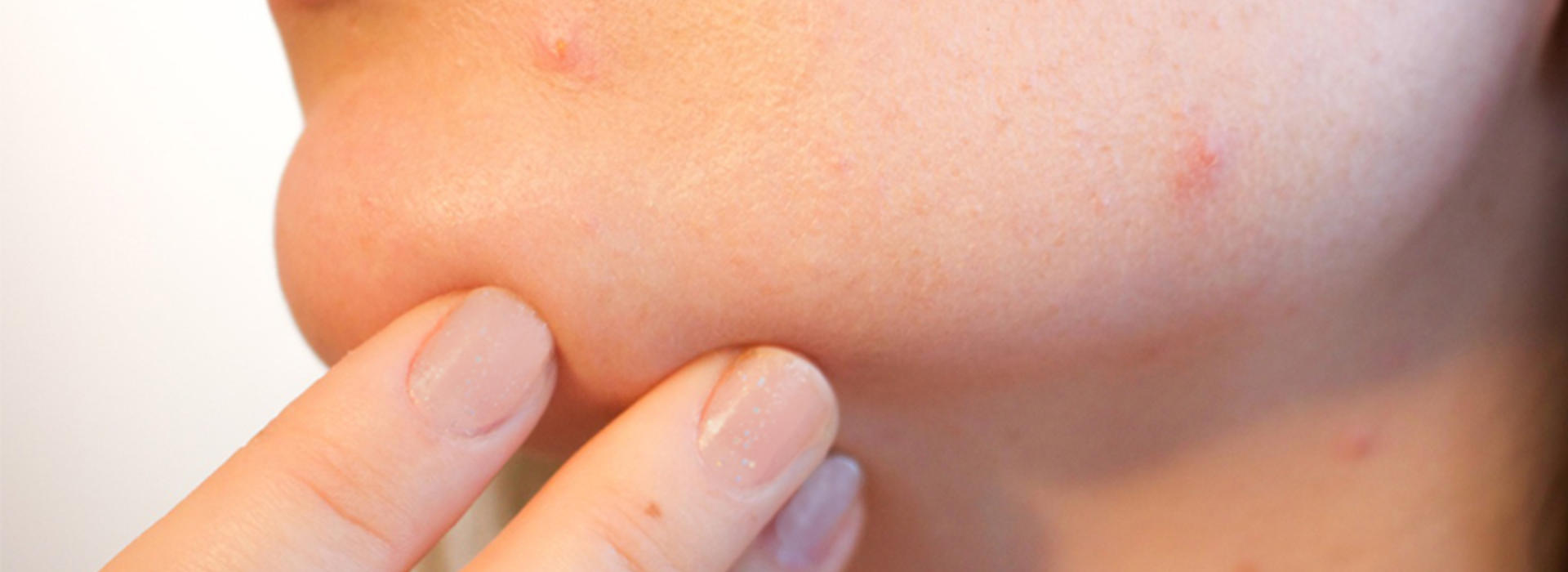 A woman's face spotted with acne.