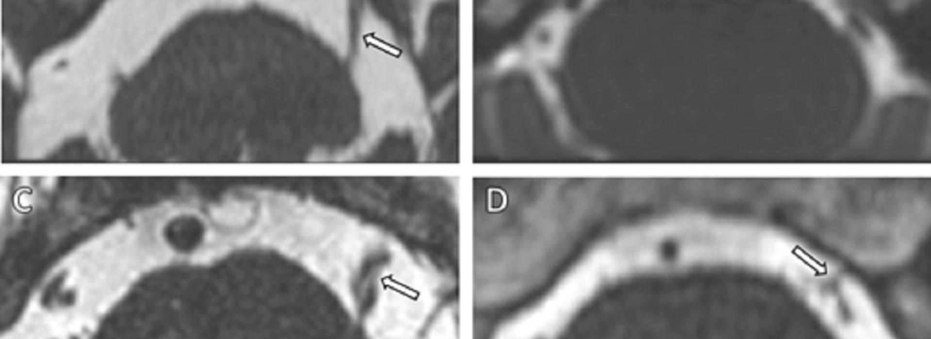 MRI used in trigeminal neuralgia study
