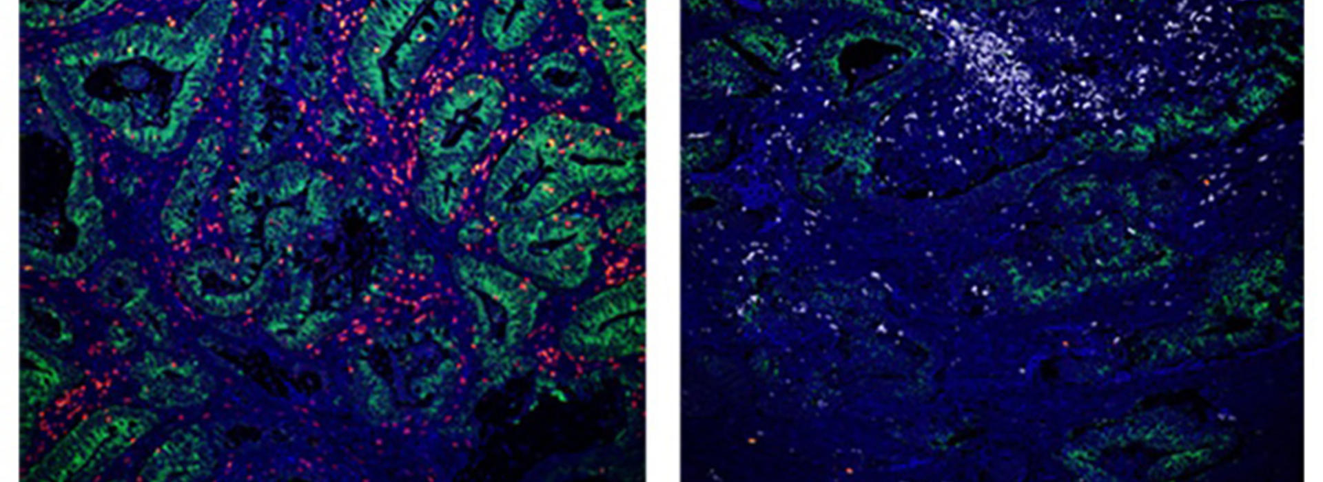 A side-by-side image showing microscopic images of colorectal cancer tumors