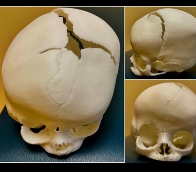 Model of Paislee Schendel's skull