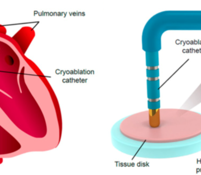 Graphic of cryoablation model