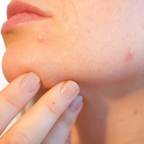 A woman's face spotted with acne.
