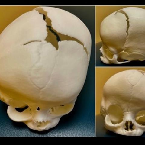 Model of Paislee Schendel's skull