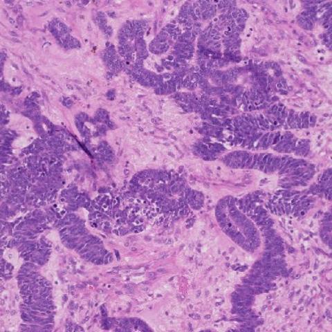 Ovarian cancer cells
