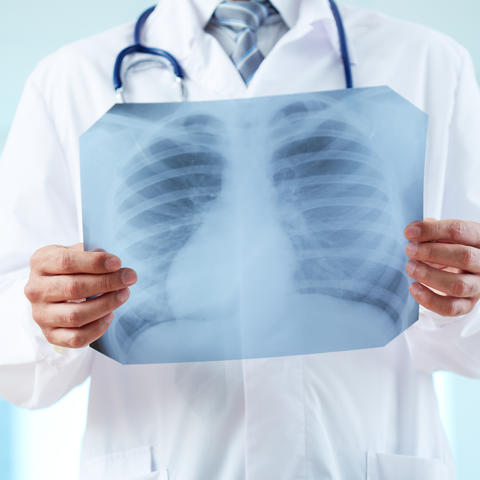 Doctor holding chest x-ray image over their ribcage