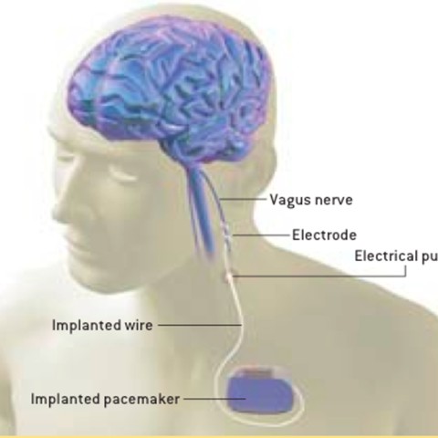 Illustration of vagus nerve stimulation